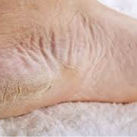 Tratamento: Ressecamento dos pés