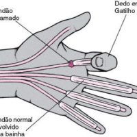 Tratamento: Tendinite ou tenossinovite digital estenosante (dedo em gatilho)