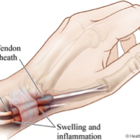 Tratamento: Tendinite estenosante dos extensores do polegar (Tenossinovite De Quervain)